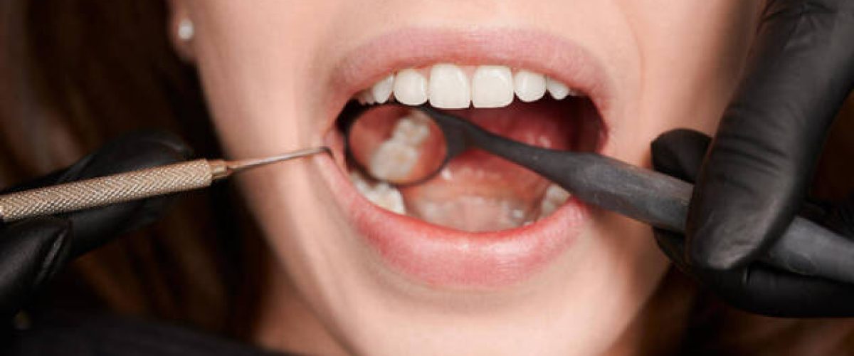 caries-saude-dental-saude-bucal-dentista-09092023121715611