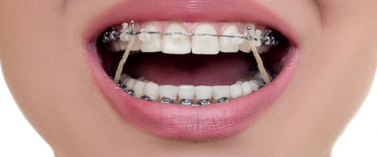 elastico-ortodontico