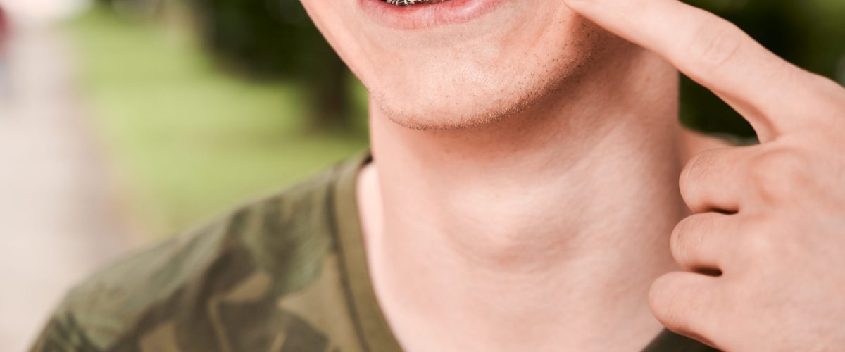 Close-up, cropped snapshot of man's smile wearing dental braces, posing outdoors, pointing at his mouth. Horizontal image. Macro photography. Concept of oral hygiene and care